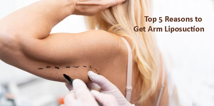 Top 5 Reasons to Get Arm Liposuction