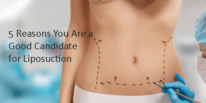 5 Reasons You Are a Good Candidate for Liposuction | Bangalore