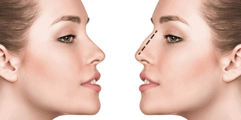 6 Common Nose Shape Concerns that Rhinoplasty can resolve