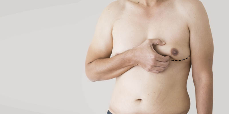 All you need to know about Gynecomastia