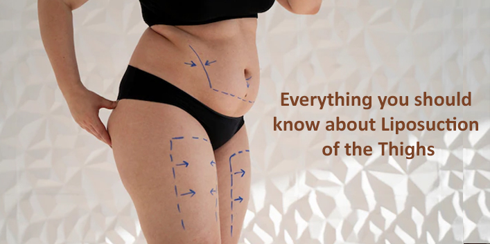 Everything you should know about Liposuction of the Thighs