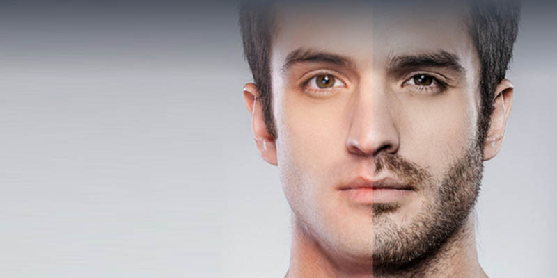 Facial Hair Transplants And Beard Transplants