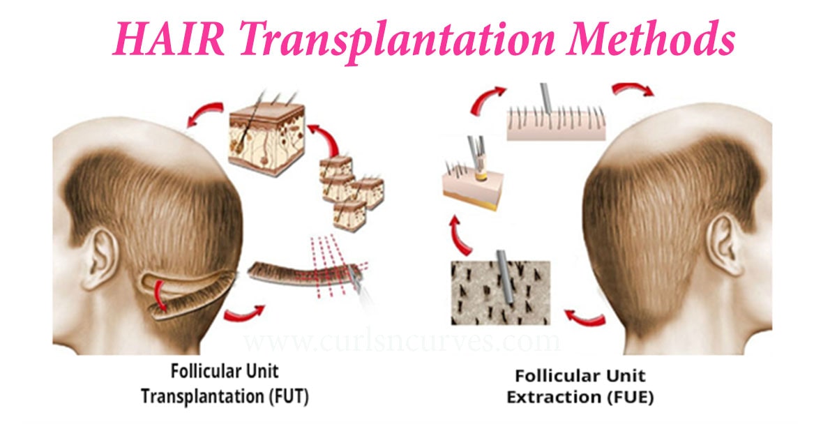 FUE vs FUT Hair Transplant Methods – Curlsncurves