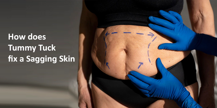 How does Tummy Tuck fix a Sagging Skin