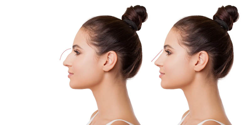 Post-Nose Job! Your recovery guide after Rhinoplasty!