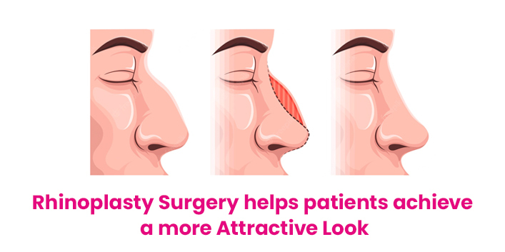 Rhinoplasty Surgery helps patients achieve a more Attractive Look