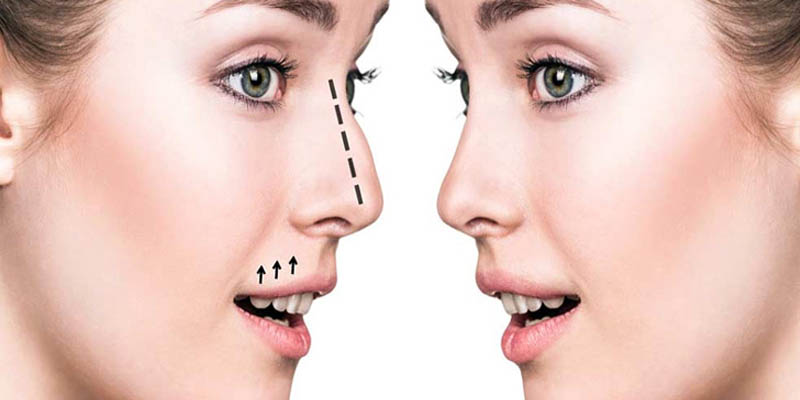 Known and Unknown facts about Rhinoplasty/Nosejob