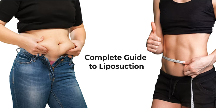 Complete Guide to Liposuction