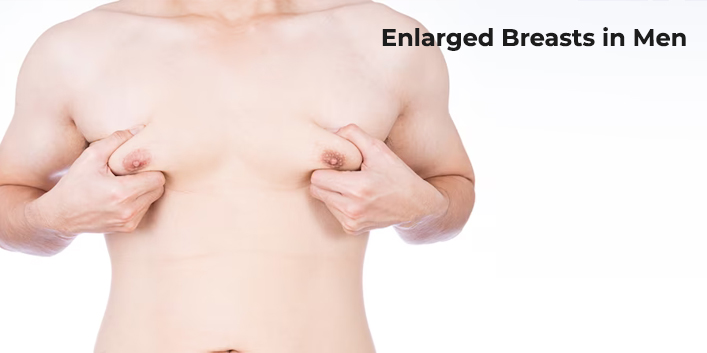 Enlarged Breasts in Men (Gynecomastia)