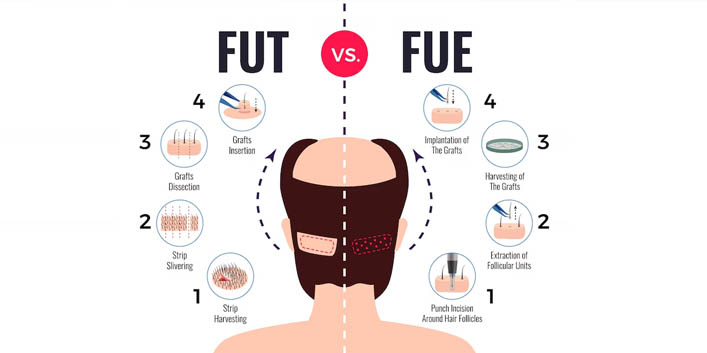 FUT Vs. FUE Hair Transplant: Which is the Best Method for Hair...