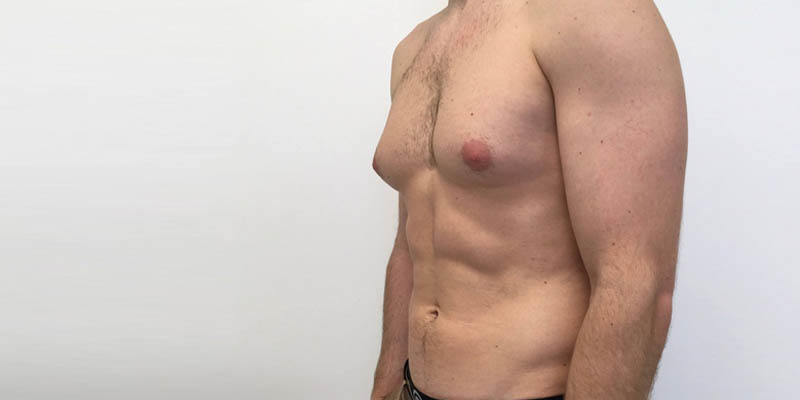 How to get rid of man boobs or fatty chest?