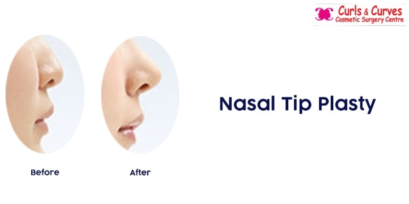Nasal tip Plasty Surgery