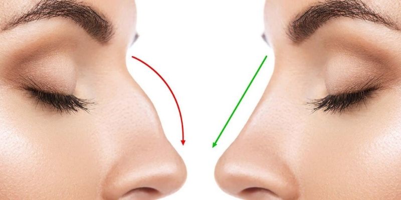 Interesting Facts you need to know about Rhinoplasty