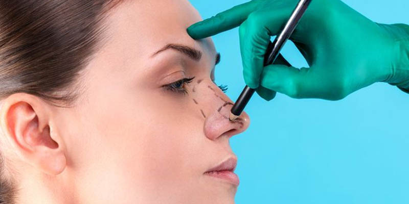 Things To Know About Rhinoplasty