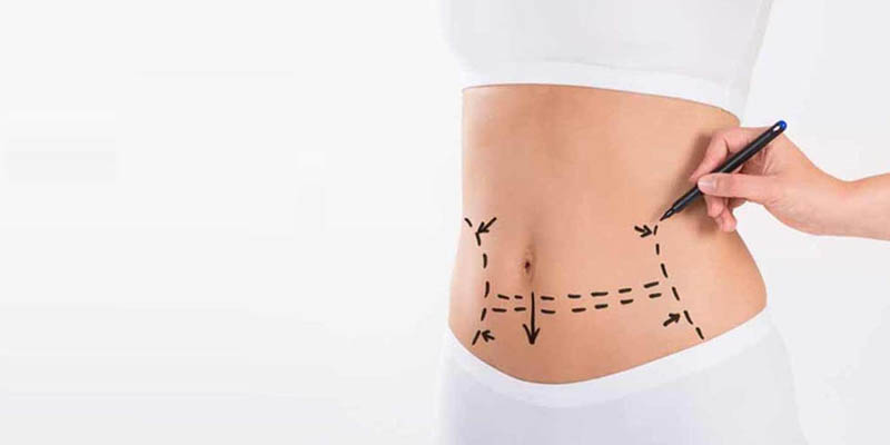 Top 5 benefits of Tummy Tuck Surgery