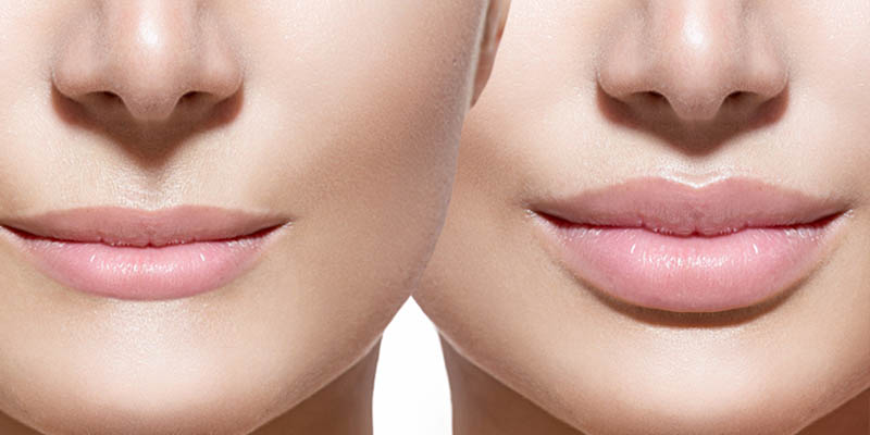 Top benefits of lip enhancement surgery!