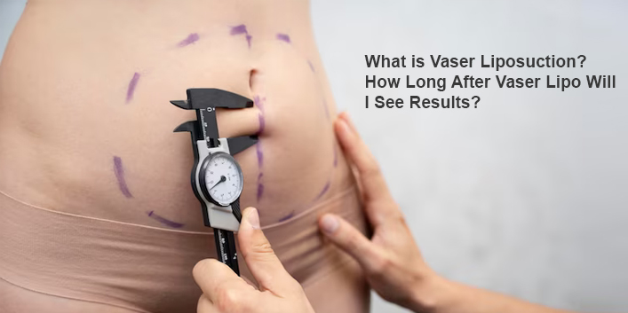 What is Vaser Liposuction? How Long After Vaser Lipo Will I Se...