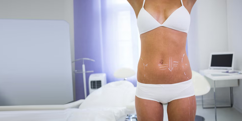 Recovery Process After Liposuction – 7 Steps for a Smooth Reco...