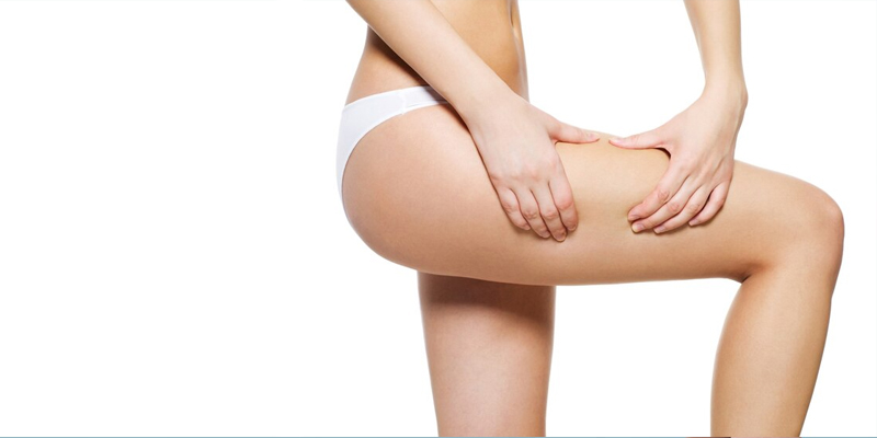 5 Reasons to Consider a Thigh Liposuction
