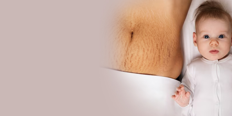 Liposuction After Pregnancy. Everything a New Mom Needs to Know