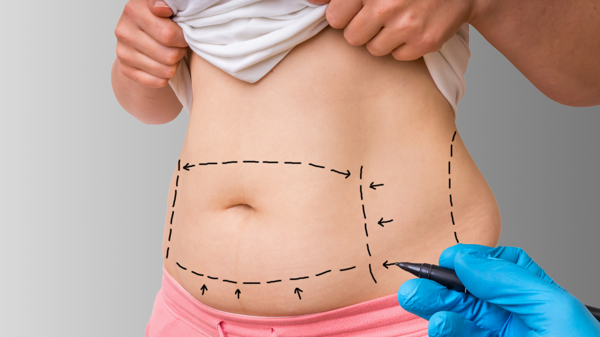 Liposuction: The Gold Standard in Body Contouring