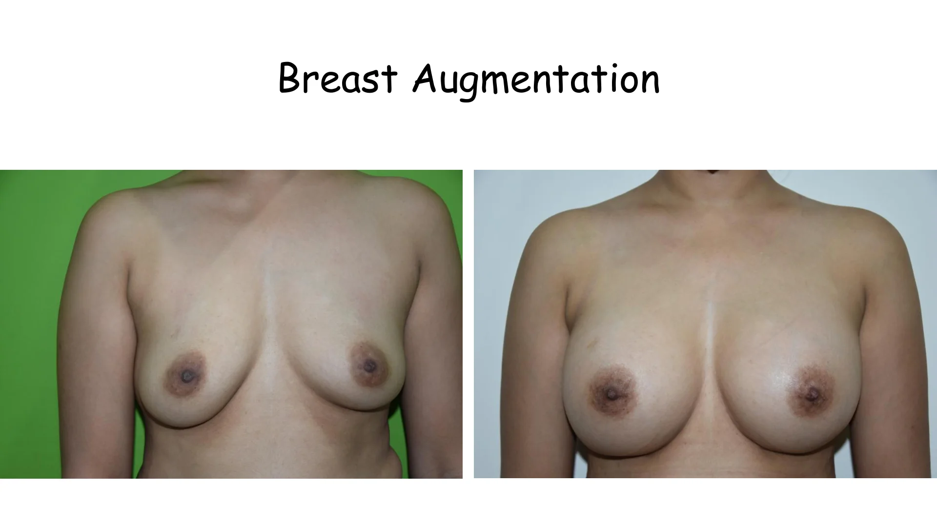 Breast Augmentation 1