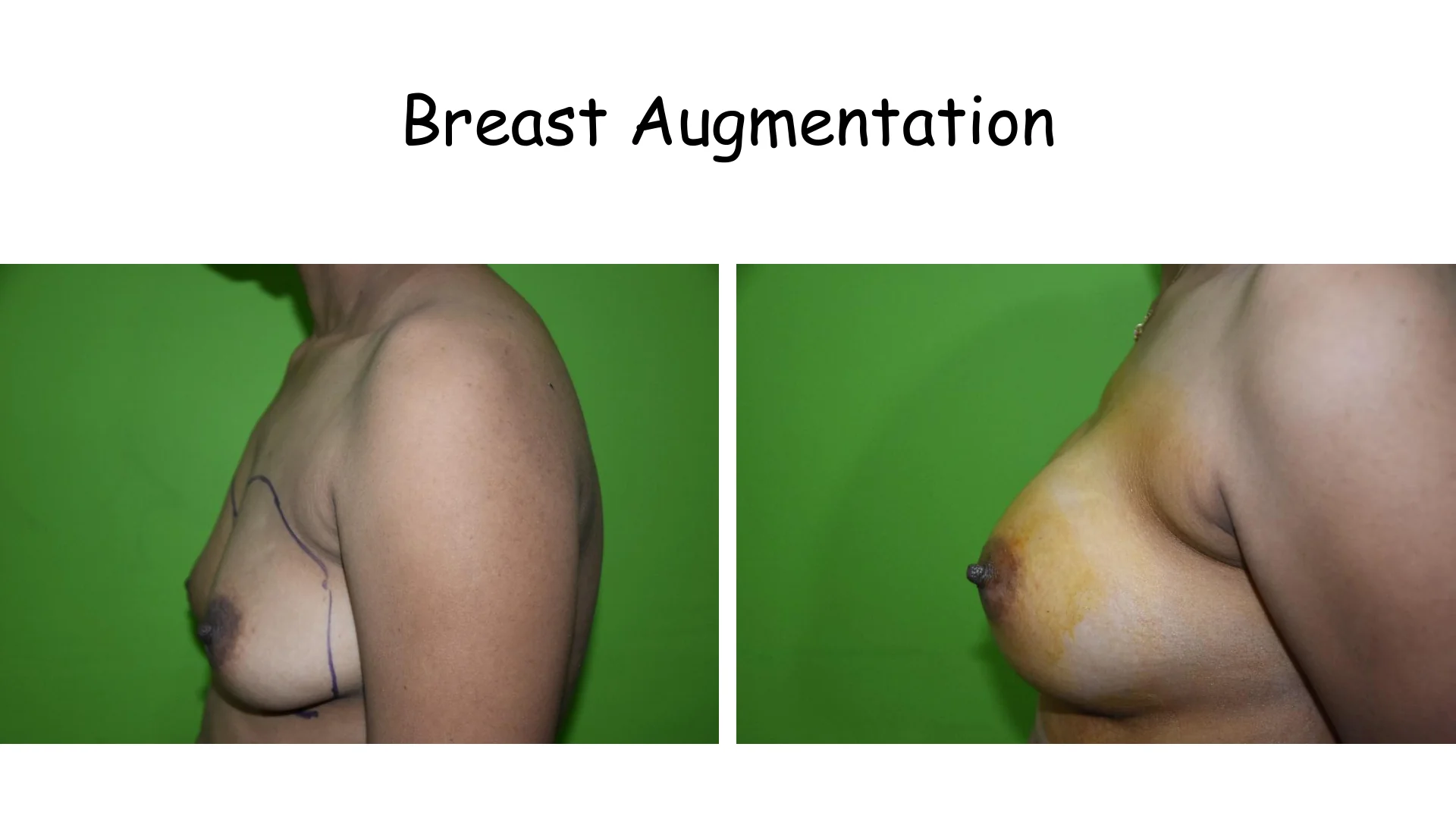 Breast Augmentation 11