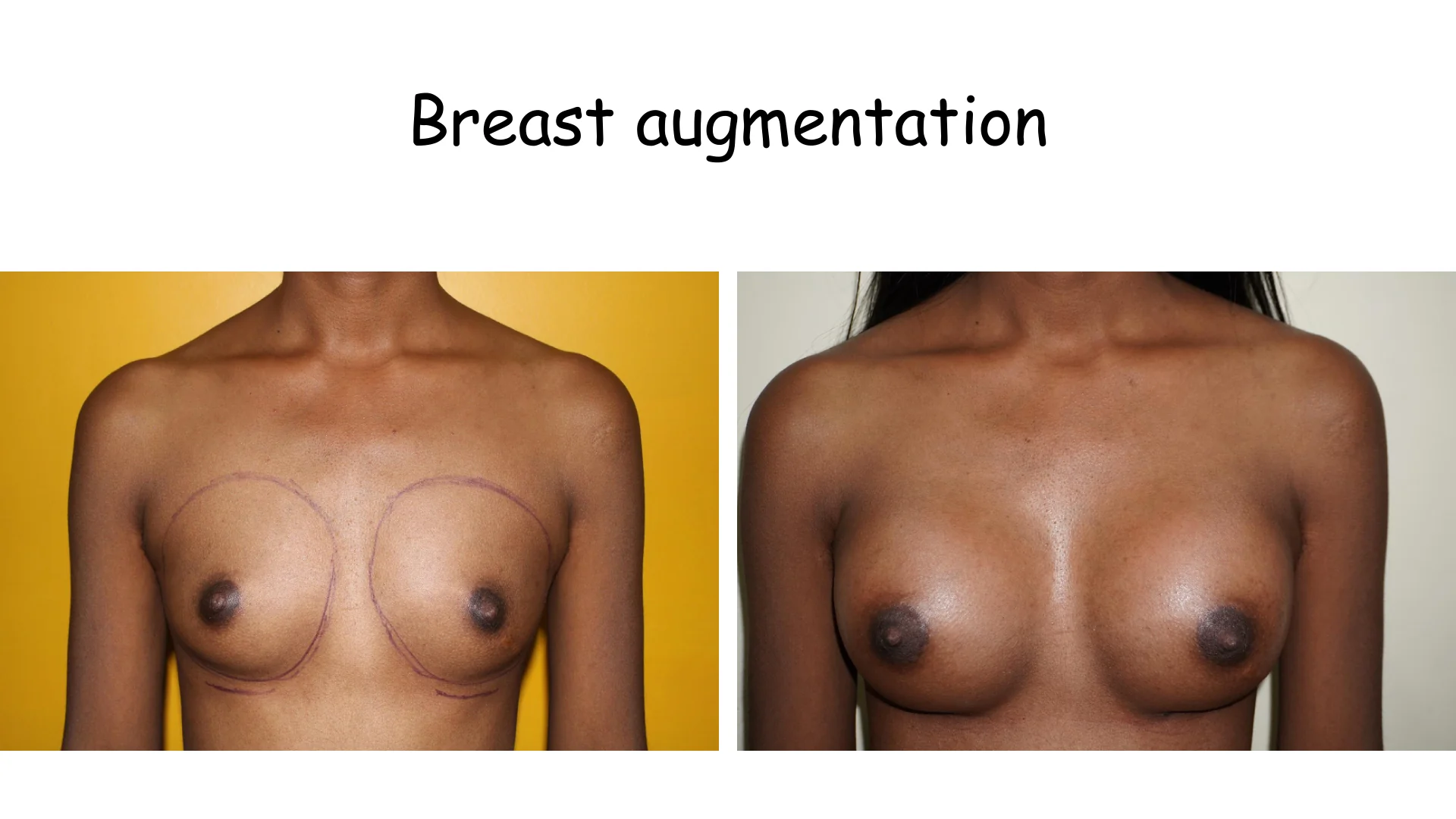 Breast Augmentation 12