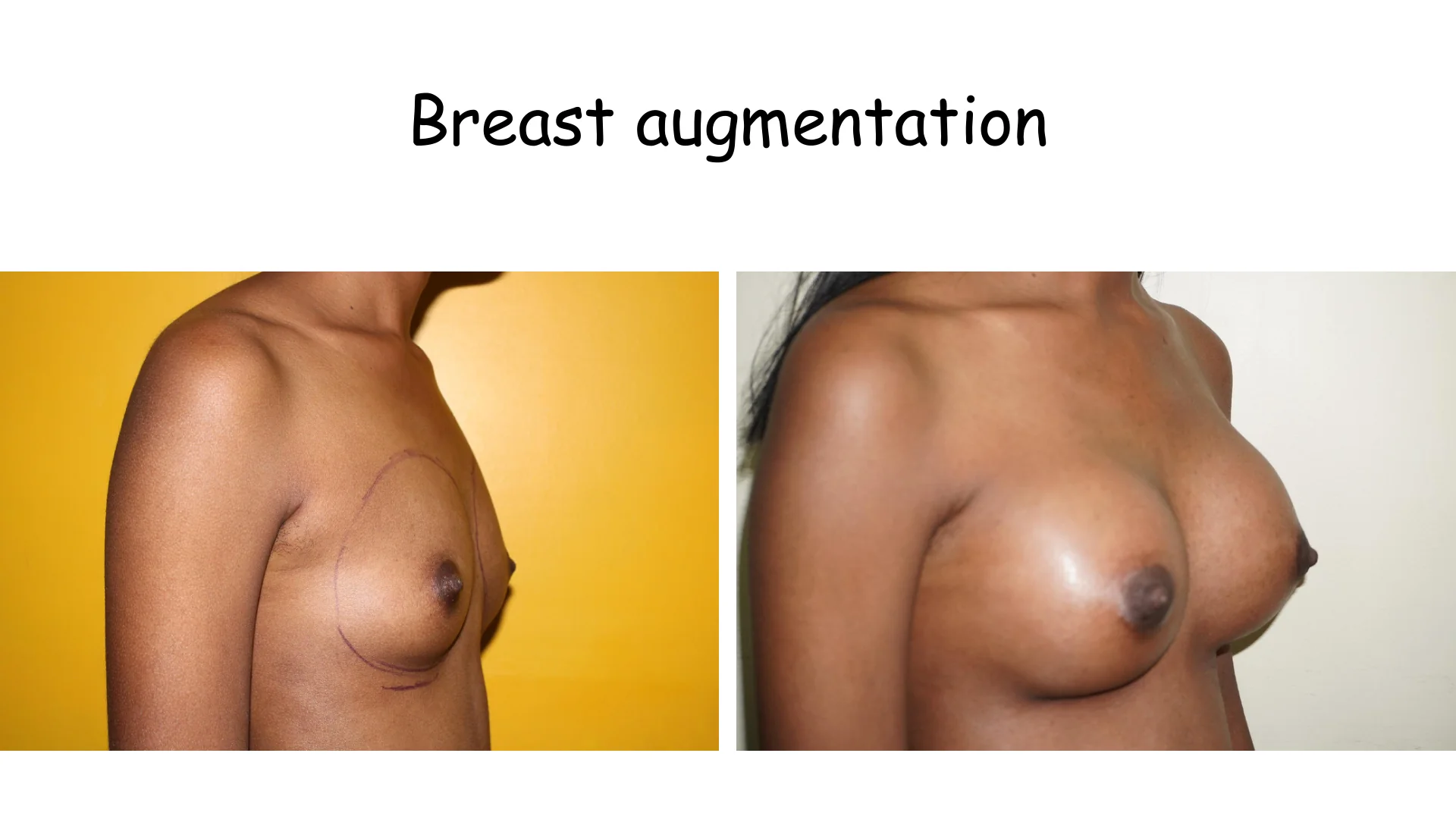 Breast Augmentation 13