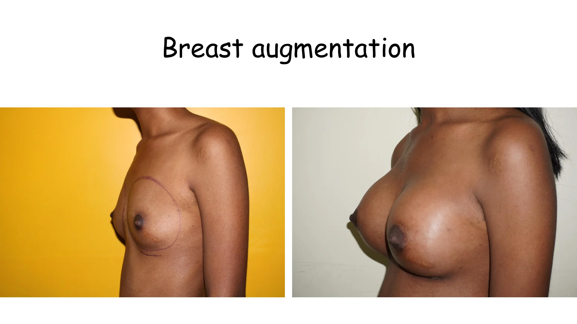 Breast Augmentation 14