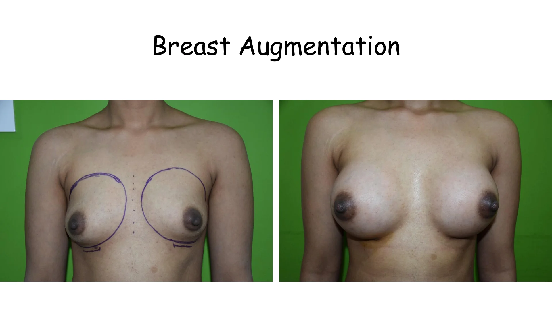 Breast Augmentation 15