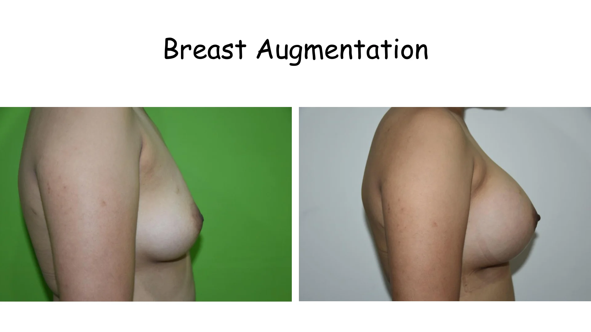 Breast Augmentation 2