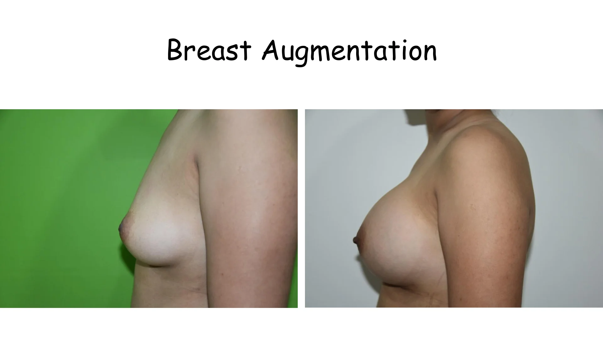 Breast Augmentation 3