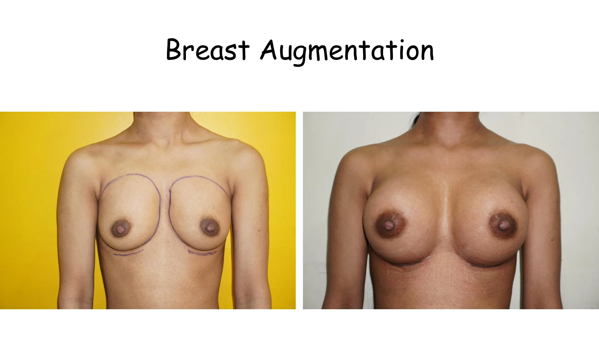 Breast Augmentation 4