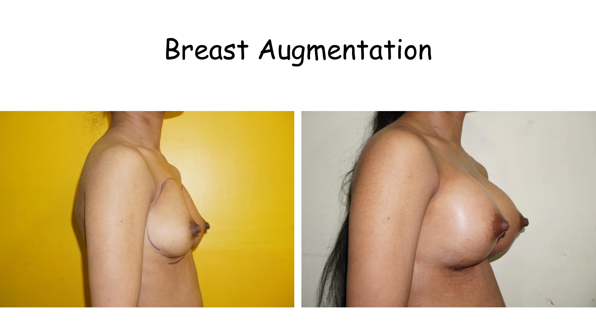 Breast Augmentation 5