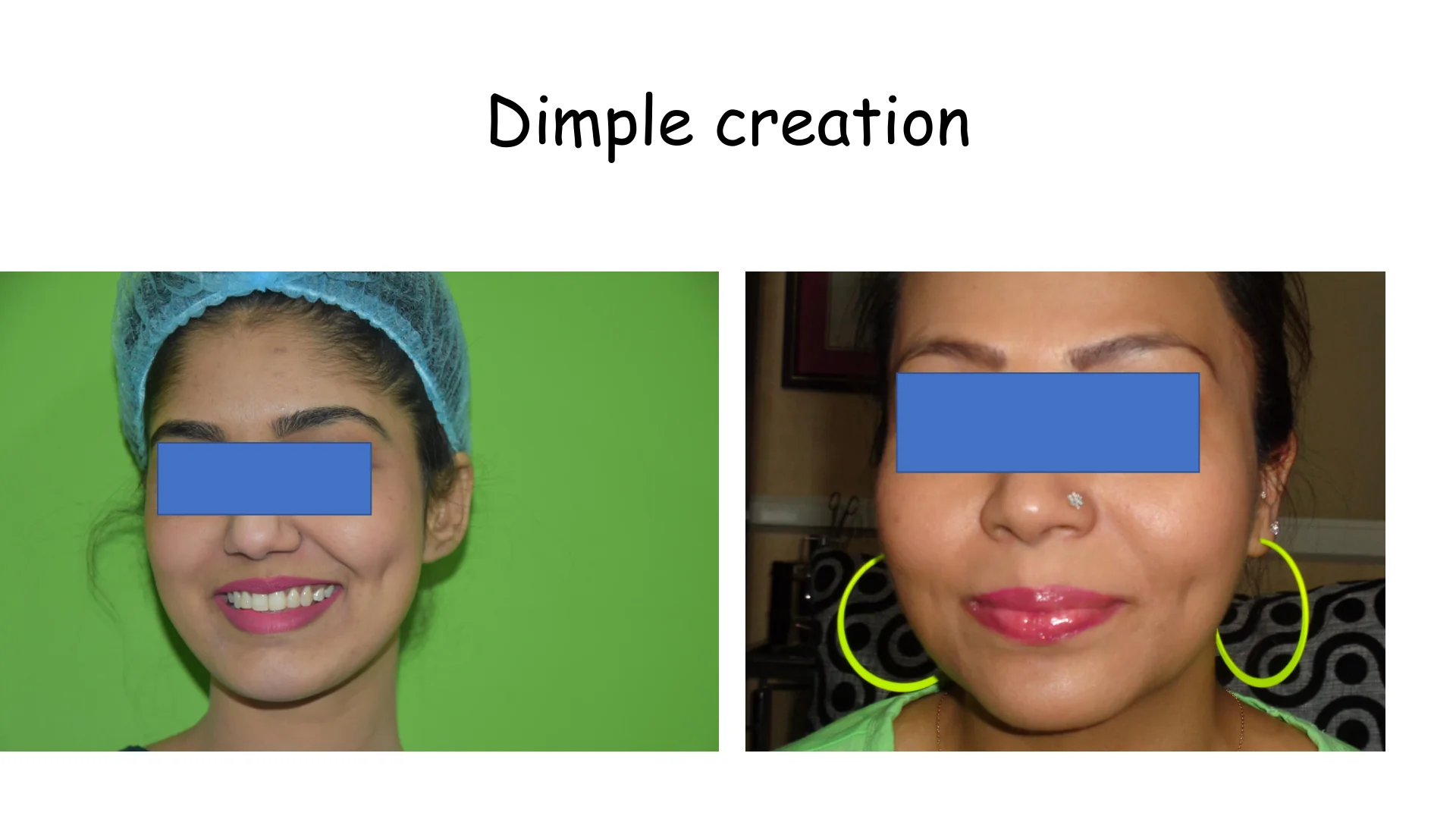 Dimple Creation 1