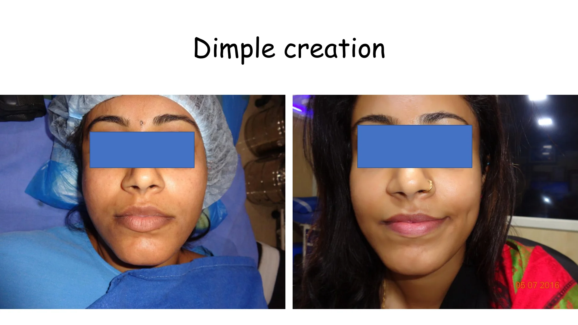 Dimple Creation 10
