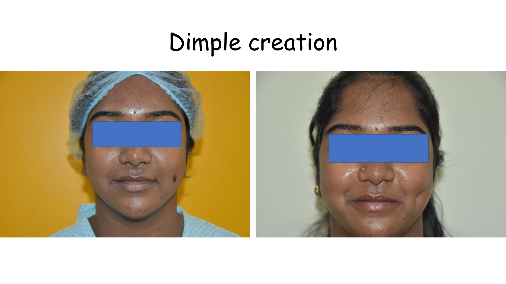 Dimple Creation 11