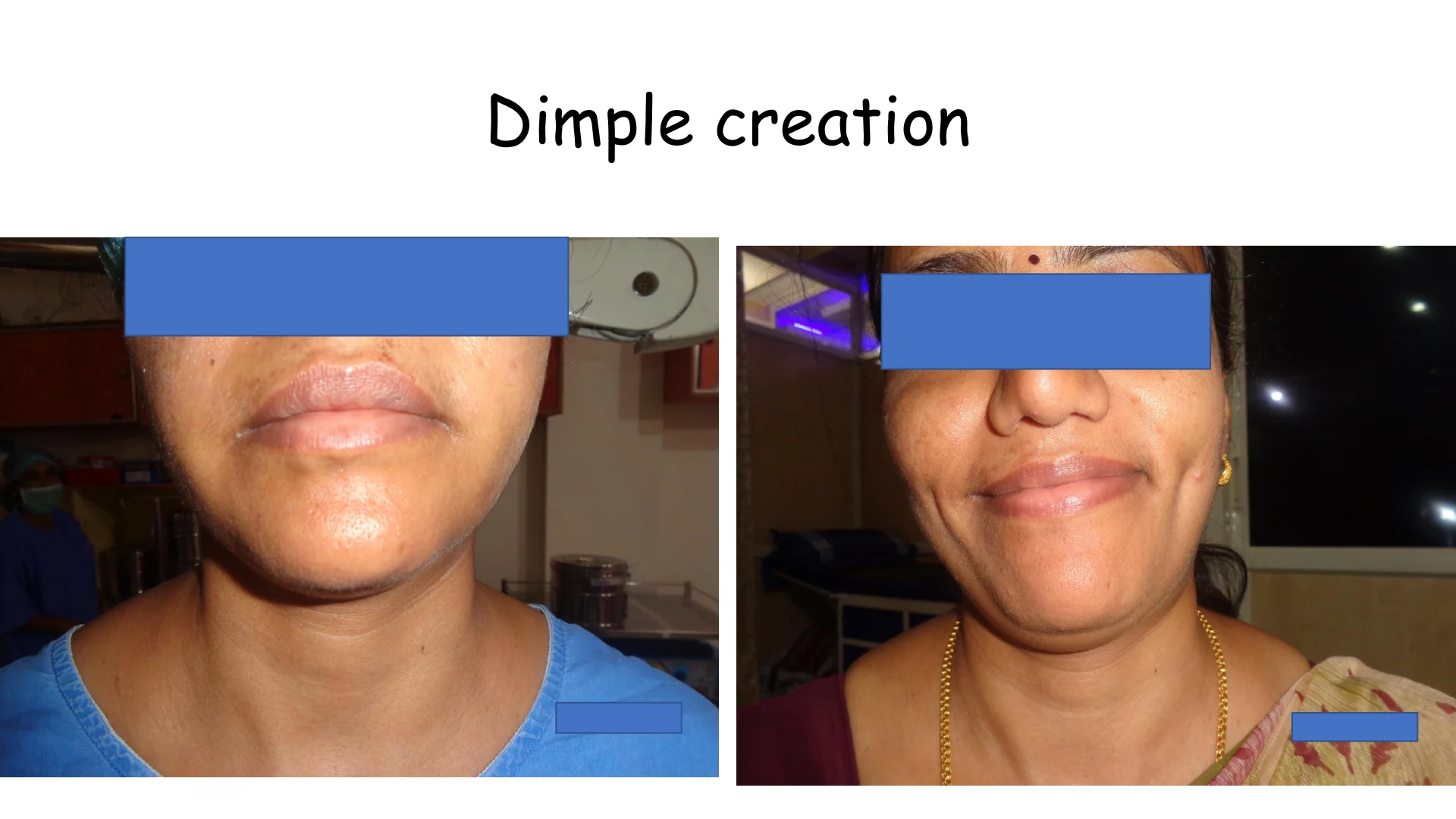 Dimple Creation 14