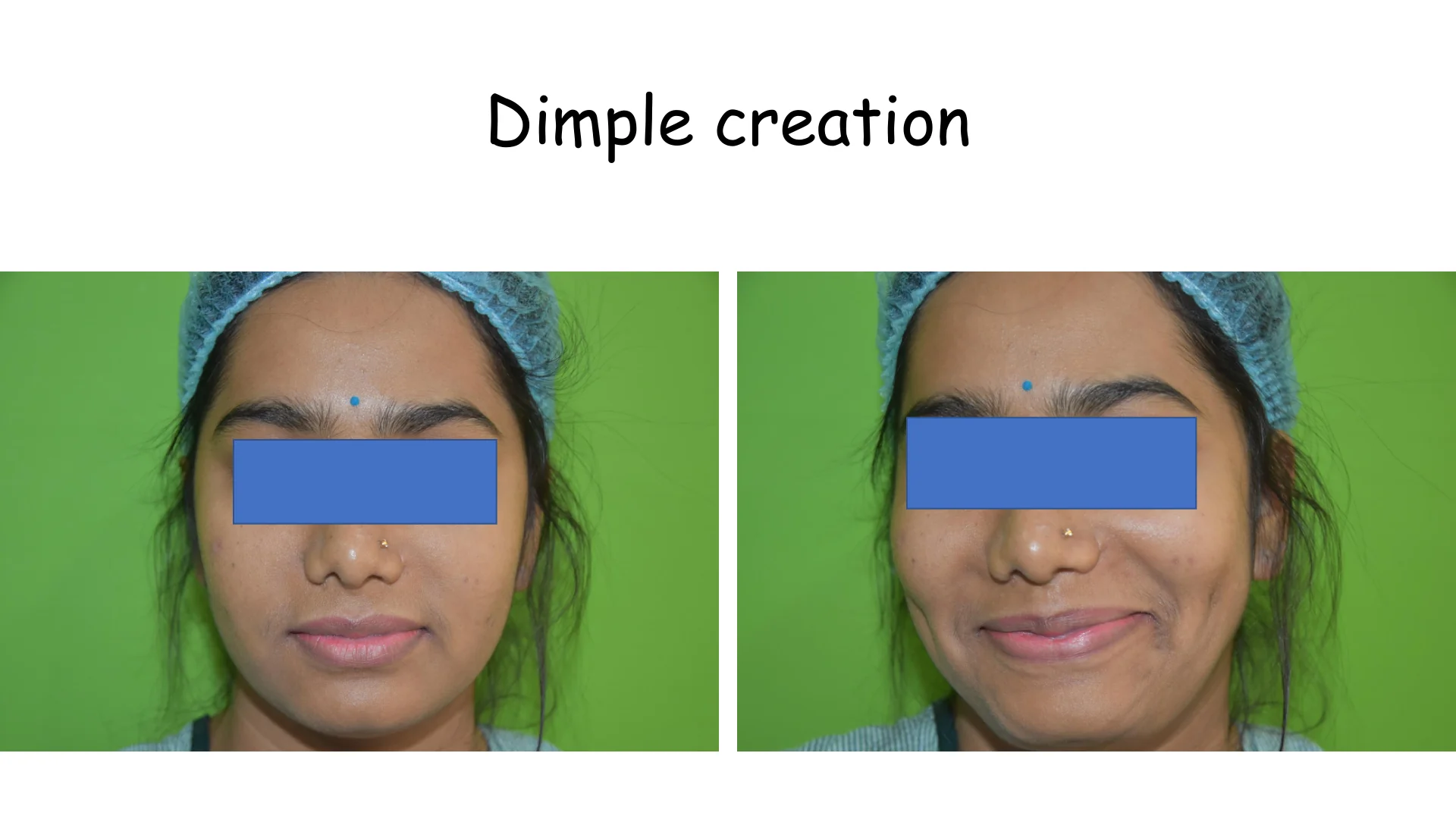 Dimple Creation 15