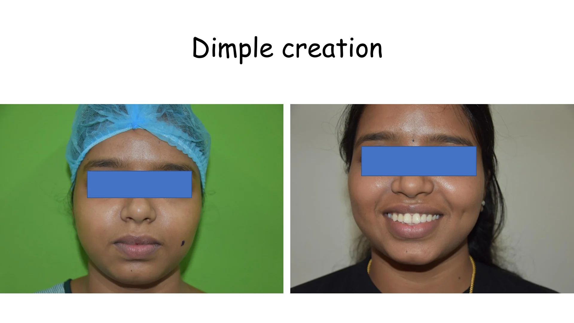 Dimple Creation 2