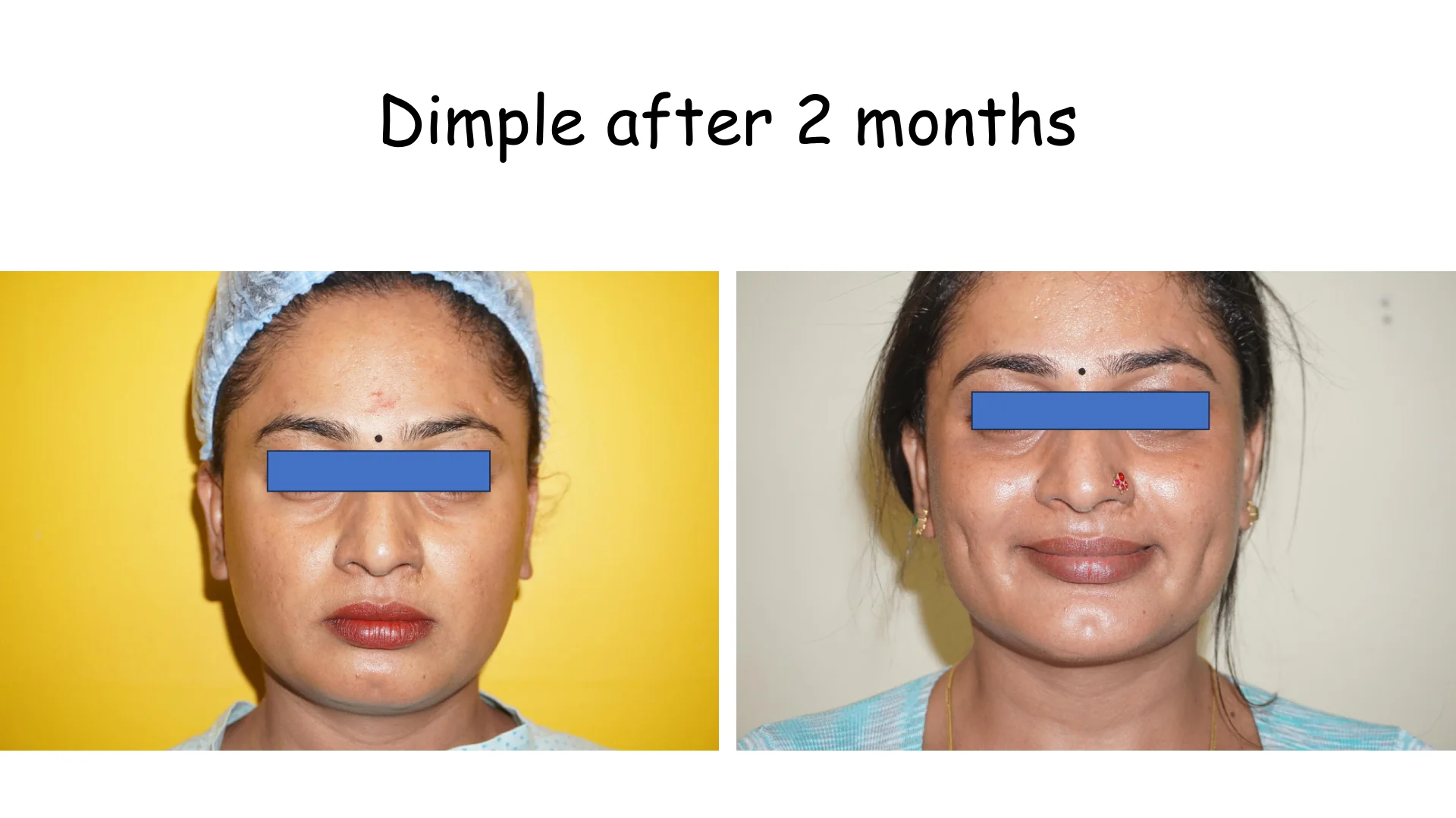 Dimple Creation 3