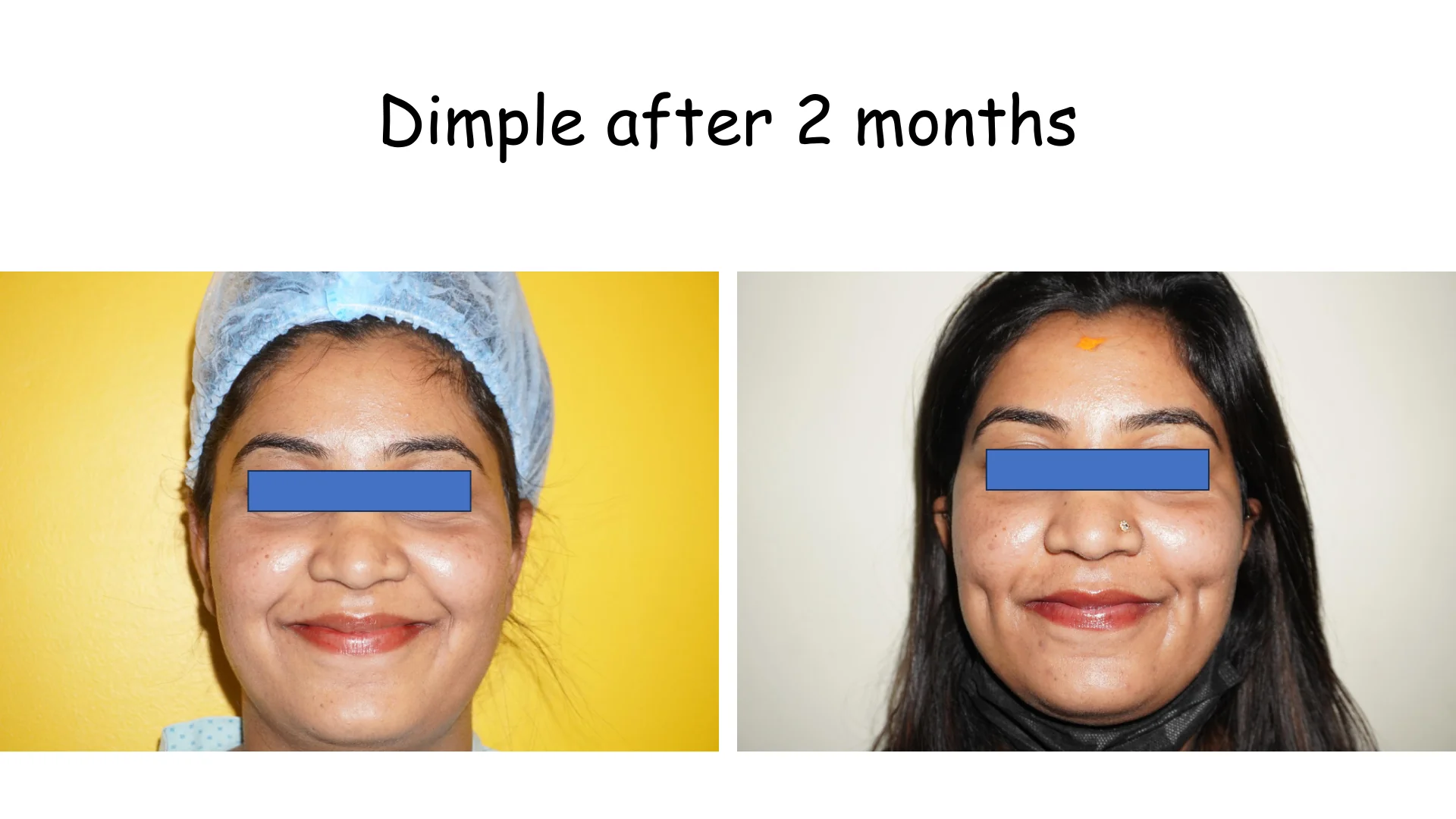 Dimple Creation 4