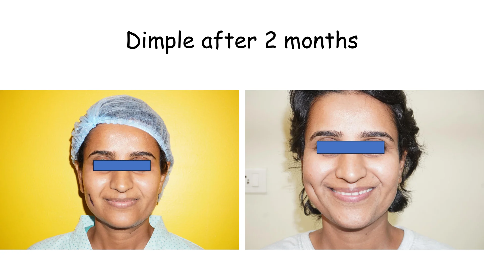 Dimple Creation 5