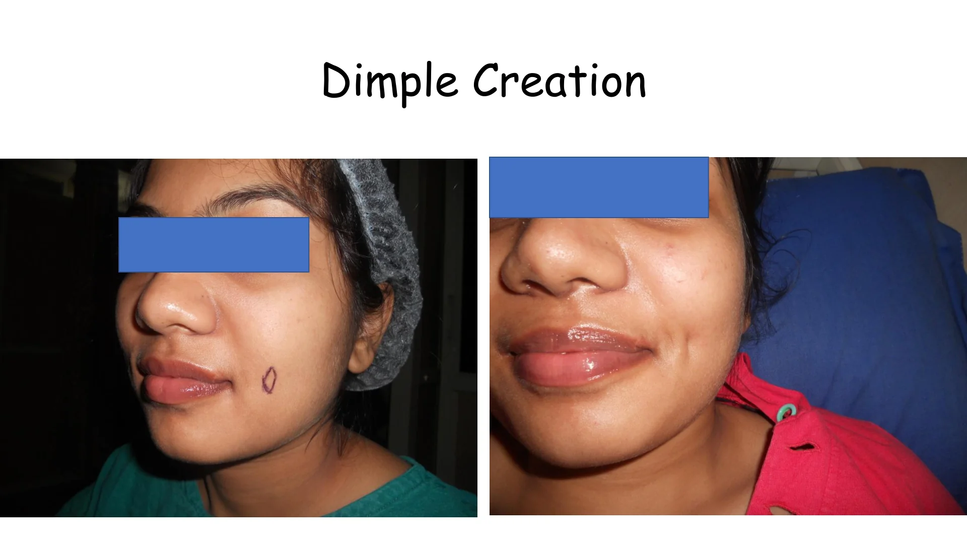Dimple Creation 6