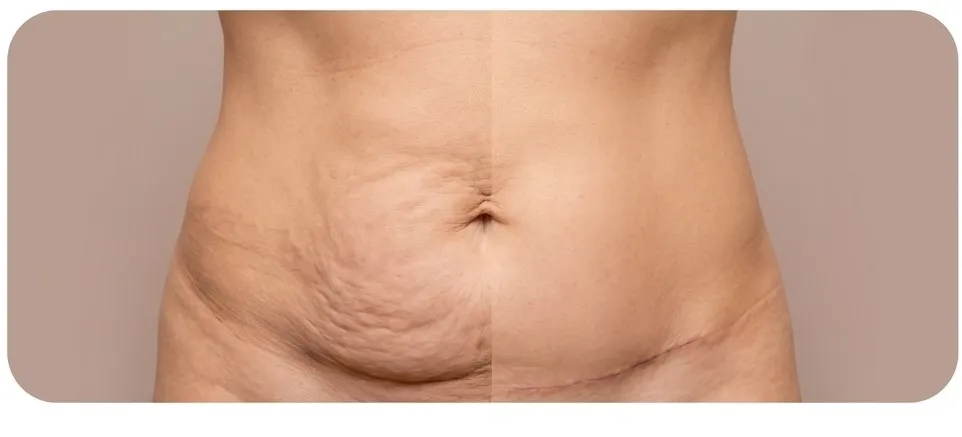 Tummy Tuck