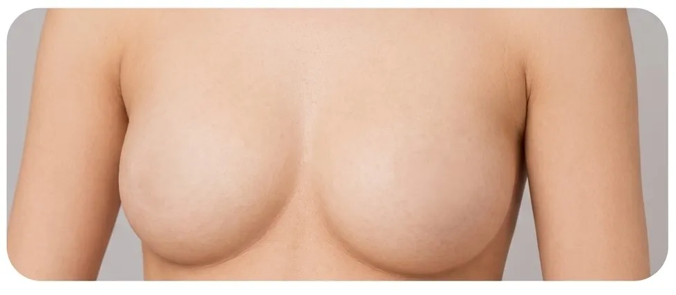 Breast Lift