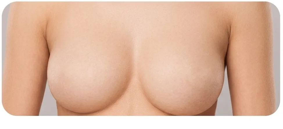 Breast Implants