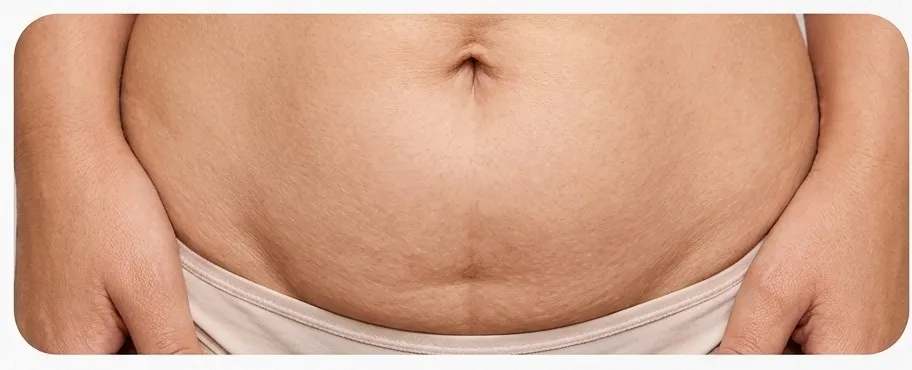 Full Tummy Tuck