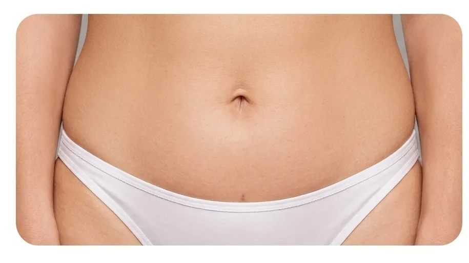 Mini Tummy Tuck